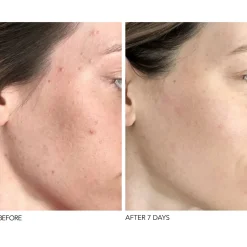 Online DR. DENNIS GROSS Alpha Beta® Universal Daily Peel 5 Pack