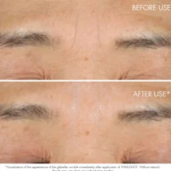 Capture Totale Hyalushot